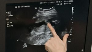 برونكوتيرول شراب والحمل