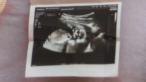 جاستروبيكسي 20 مجم والحمل