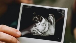 نانازوكسيد 500 والحمل